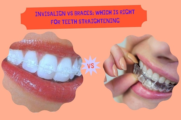 Invisalign vs Braces Which is right for Teeth Straightening