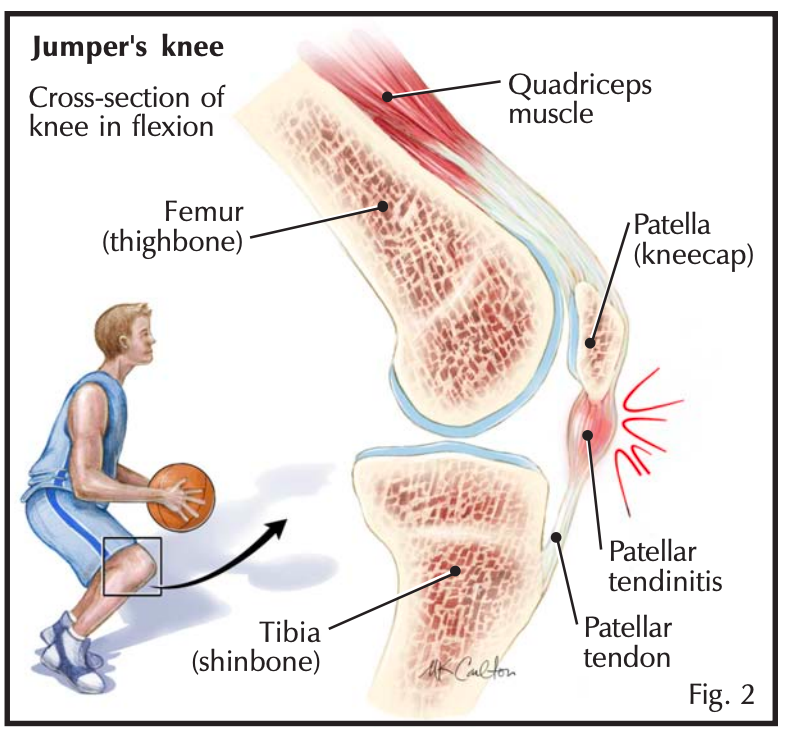 Jumper’s Knee – Diagnosis and Treatment