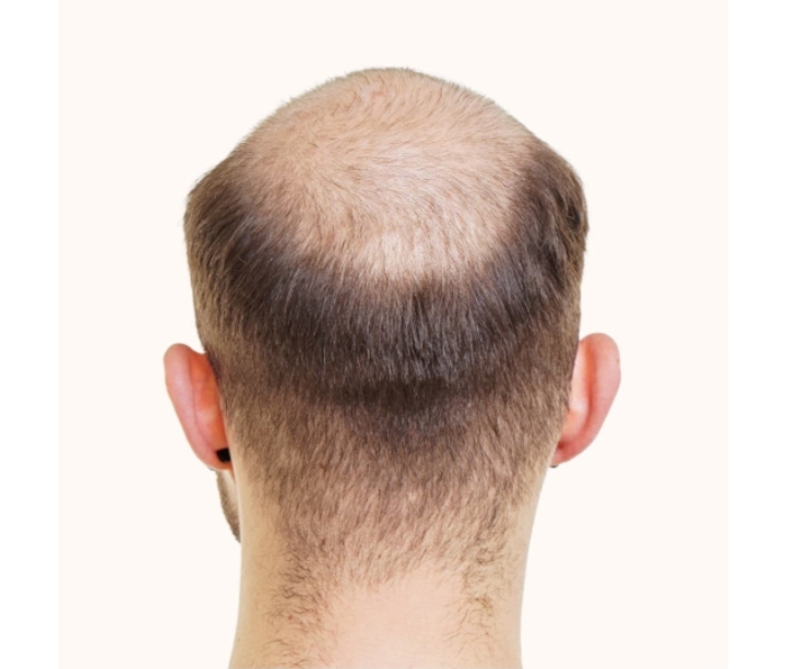 How Much Does it Cost For a Hair Transplant in Dubai?